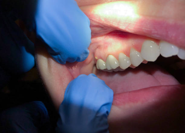 Best Chipped Tooth Repair Near Me  in North Edwards, CA